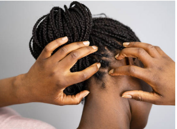 Dandruff, Scalp, and Related